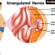 Stragulated Hernia